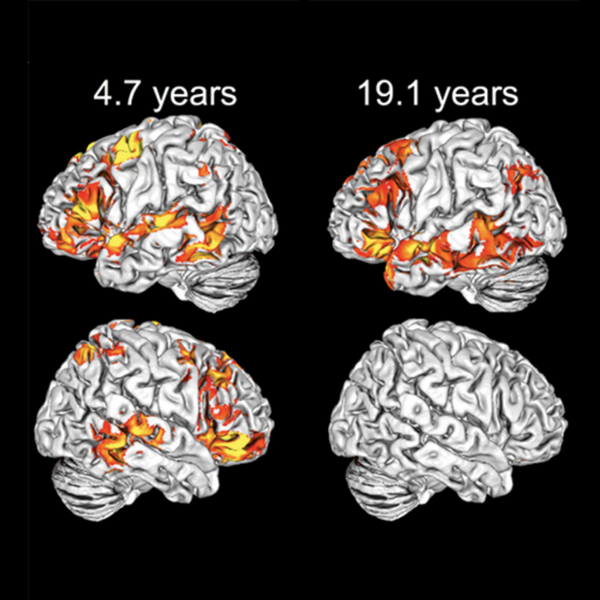 Children Use Both Brain Hemispheres to Understand Language, Unlike Adults